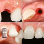 Как вставляются импланты зубов?