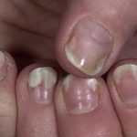 Причины и лечение отслоения ногтя